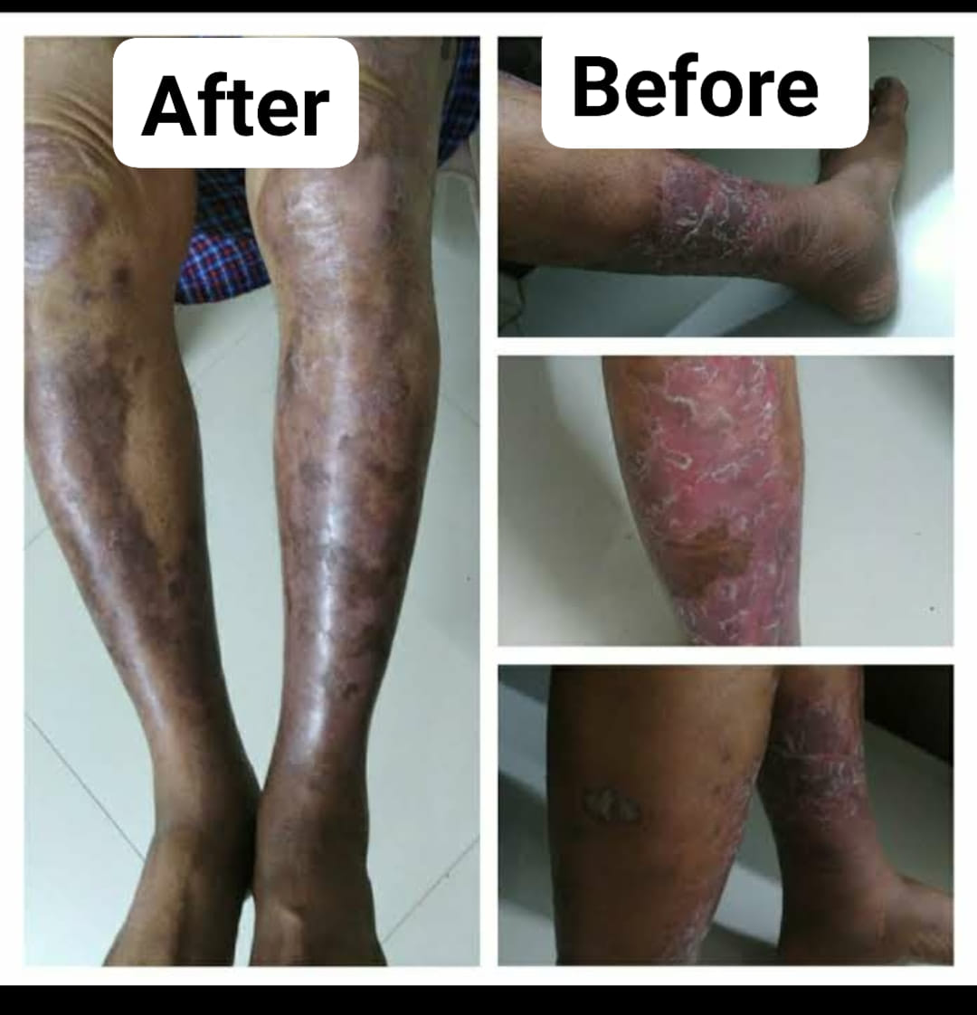 Before and After Skin Allergy patient recovery Pune